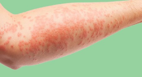 atopische dermatitis