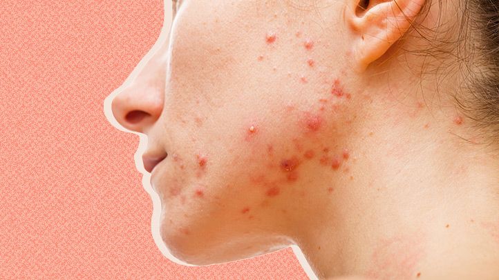 Kan het 'resetten' van je hormonen je huid verbeteren?