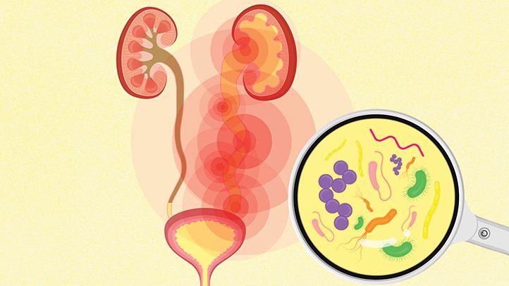 Wat is een urineweginfectie (UTI)? Symptomen, oorzaken, diagnose, behandeling en preventie